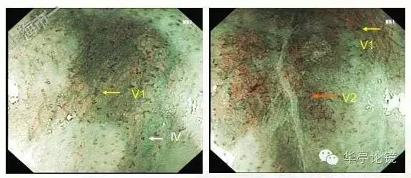 6个精彩病例带你领略早期食管癌的内镜下诊治