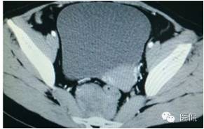 病例丨病理结果「医看2016苏州阅片大赛」病例资料11：血管肌纤维母细胞瘤#医学影像#