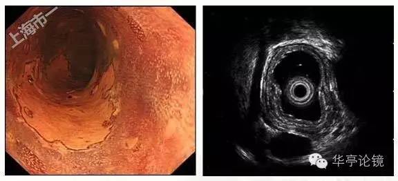 6个精彩病例带你领略早期食管癌的内镜下诊治
