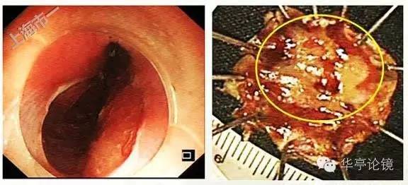 6个精彩病例带你领略早期食管癌的内镜下诊治