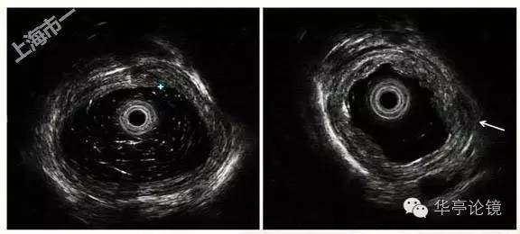 6个精彩病例带你领略早期食管癌的内镜下诊治