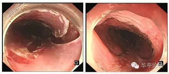 6个精彩病例带你领略早期食管癌的内镜下诊治