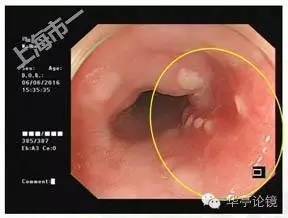 6个精彩病例带你领略早期食管癌的内镜下诊治