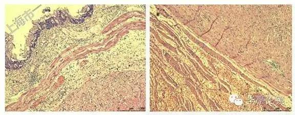 6个精彩病例带你领略早期食管癌的内镜下诊治