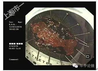 6个精彩病例带你领略早期食管癌的内镜下诊治