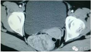 病例丨病理结果「医看2016苏州阅片大赛」病例资料11：血管肌纤维母细胞瘤#医学影像#