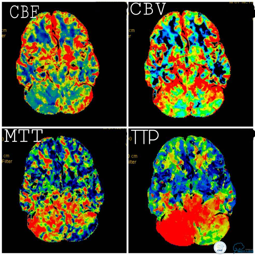 天坛周记|右椎动脉V4段慢性闭塞血管内介入治疗再通一例