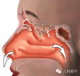 上气道咳嗽综合征,上气道咳嗽综合征挂什么科