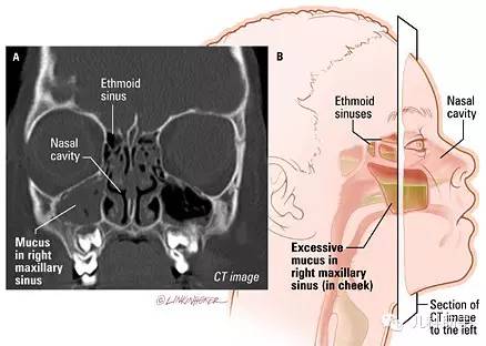 上气道咳嗽综合征,上气道咳嗽综合征挂什么科