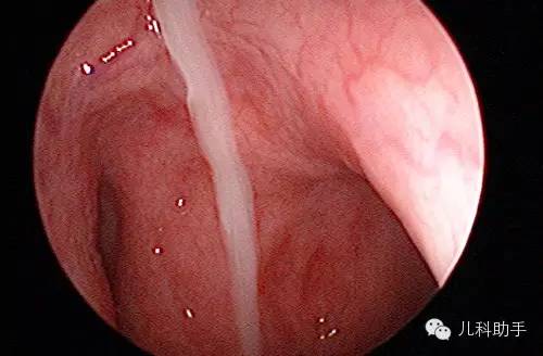 上气道咳嗽综合征,上气道咳嗽综合征挂什么科