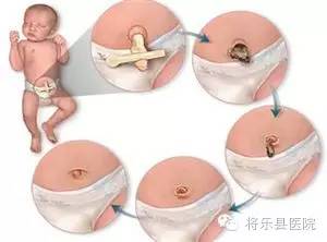 妇产科涨知识,涨知识剖宫产前后的护理事项