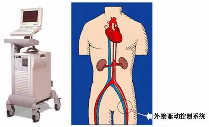 主动脉内球囊反搏的临床应用现状和进展