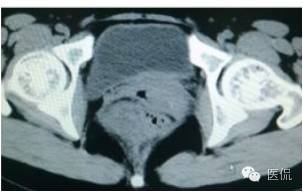 病例丨病理结果「医看2016苏州阅片大赛」病例资料11：血管肌纤维母细胞瘤#医学影像#