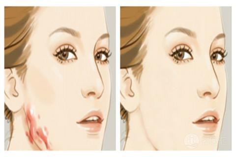 疤痕压迫疗法教学,青春疤痕有效疗法