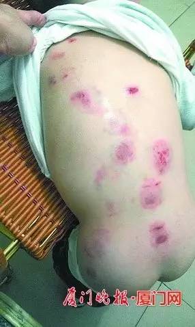 word神啊，安兜成长幼儿园小男宝被咬19处伤口！