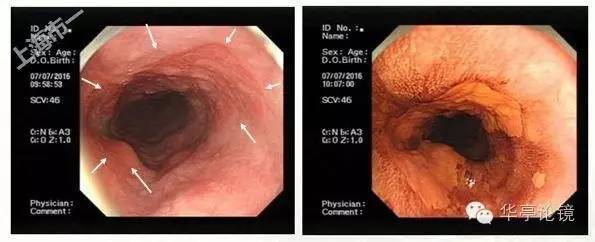 6个精彩病例带你领略早期食管癌的内镜下诊治