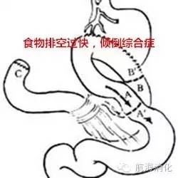 鑳冨垏闄ゆ伅鑲夊悗12灏忔椂楗,鑳冭偁鎭倝鍒囬櫎鍚庝竴鍛ㄥ悗楗