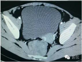 病例丨病理结果「医看2016苏州阅片大赛」病例资料11：血管肌纤维母细胞瘤#医学影像#