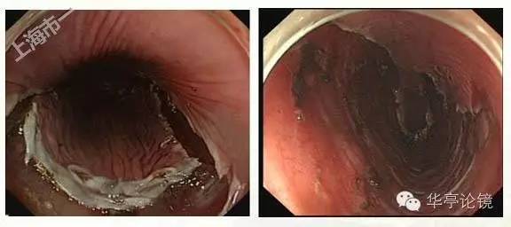6个精彩病例带你领略早期食管癌的内镜下诊治