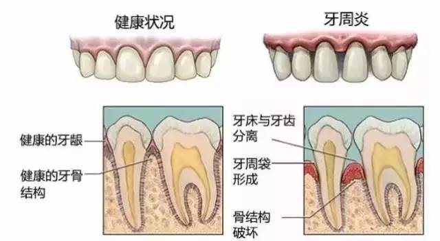 牙齿比较容易塞牙可以解决吗,牙齿总是塞牙需要去医院吗