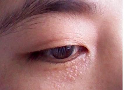 眼部脂肪粒可以消退吗,眼部脂肪粒自愈的最佳小妙招