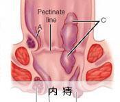 内痔的治疗方法和注意事项,内痔的治疗方法有哪些