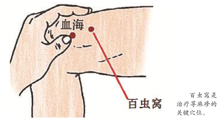 过敏性荨麻疹如何快速止痒,麻疹最快治疗方法中药
