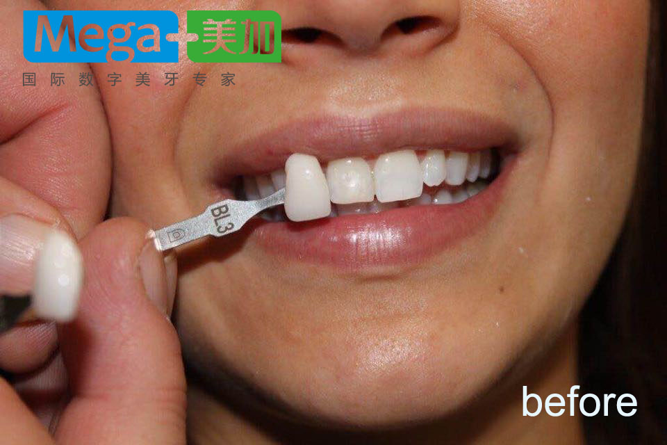 明星的牙用什么美白的,牙齿美白全过程视频
