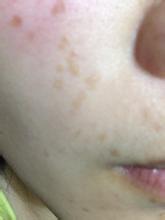 妙招姐解决痘印,为什么痘印老是顽固不化