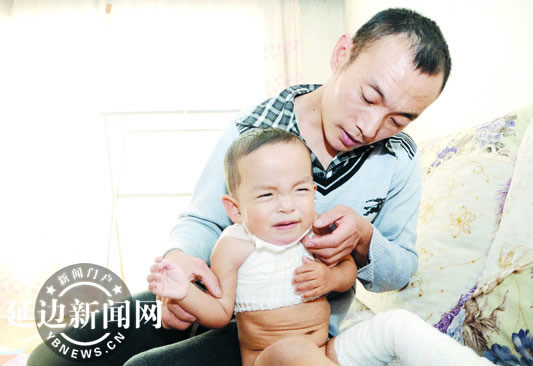 两岁半男孩打翻菜汤全身烫伤面积达70%