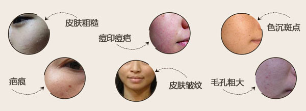 痘坑激光治疗视频,像素激光祛痘坑