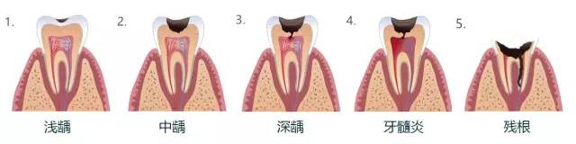 很多蛀牙有洞怎么处理,多颗蛀牙为什么要分别去弄