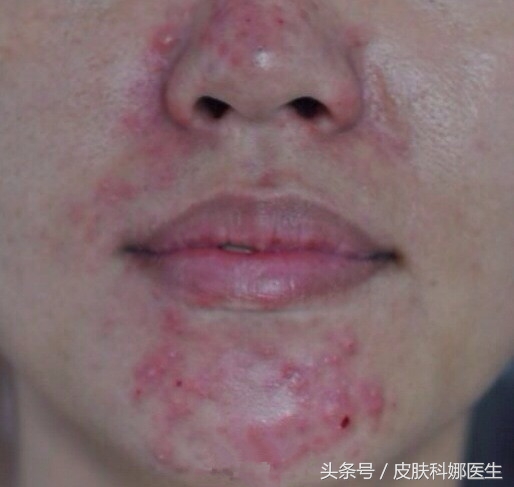 脸上皮肤发红有小红点怎么回事,脸部发红有黄到底是炎症还是敏感