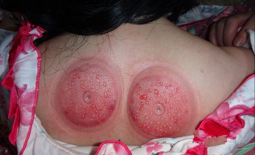 怎么通过拔罐的颜色判断身体状况,肩膀拔罐后颜色黑紫是怎么回事