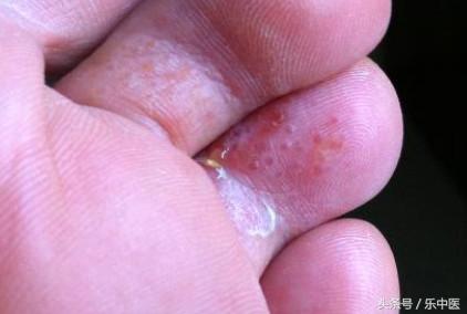 得了脚气需要忌口吗,得了脚气很烦人记住这两步帮到你