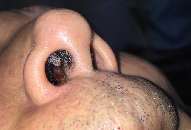 瘊子有传染性，用手乱抓乱抠，结果瘊子可能会越来越多