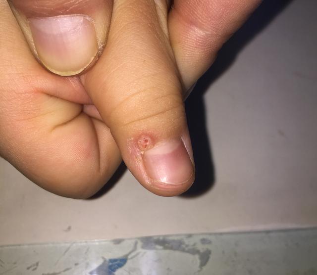 瘊子有传染性，用手乱抓乱抠，结果瘊子可能会越来越多