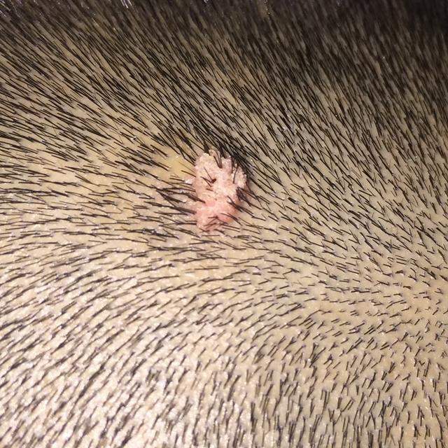 瘊子有传染性，用手乱抓乱抠，结果瘊子可能会越来越多