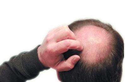 发现老公秃顶怎么办,老公结完婚以后开始秃头怎么办