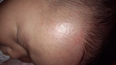 幼儿急疹出疹子期间注意事项,发烧以后出疹子需要注意什么