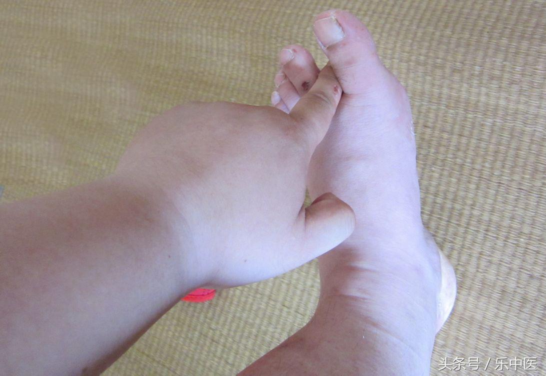 得了脚气需要忌口吗,得了脚气很烦人记住这两步帮到你