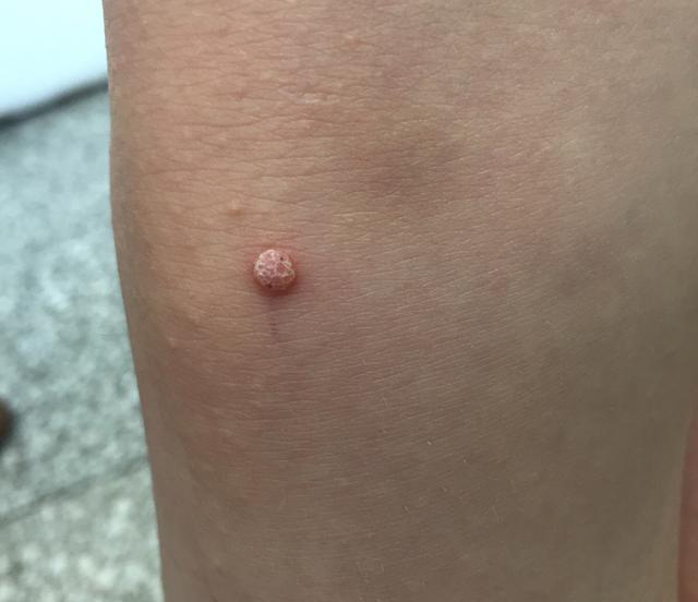 瘊子有传染性，用手乱抓乱抠，结果瘊子可能会越来越多