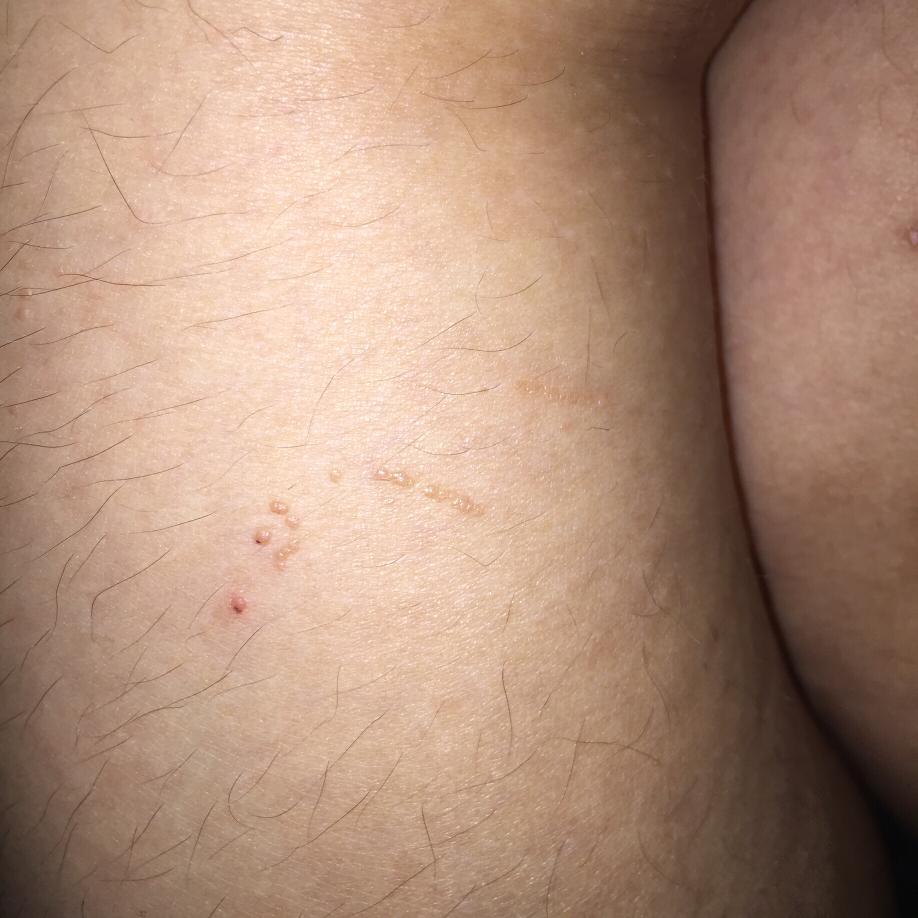 瘊子有传染性，用手乱抓乱抠，结果瘊子可能会越来越多