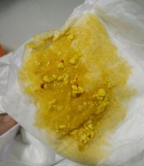 宝宝粑粑有红血丝还有果冻粘稠,宝宝拉冻冻的便便怎么回事