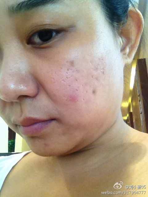 妙招姐解决痘印,为什么痘印老是顽固不化