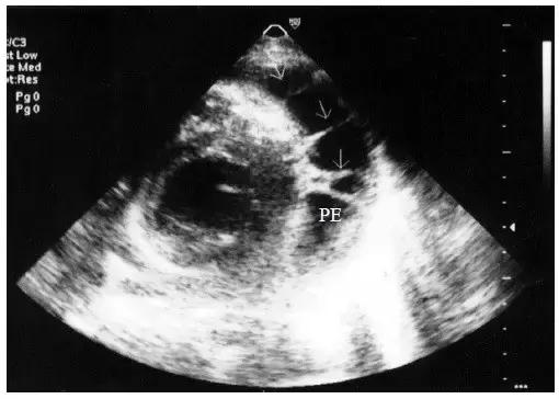 超声诊断心包腔积液,心包积液的超声诊断与鉴别