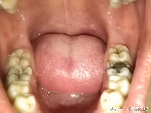 满口蛀牙的图片,满口蛀牙毁终身