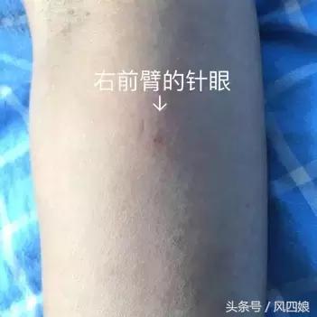 留置针打手背容易鼓包,打留置针后手臂疼怎么办