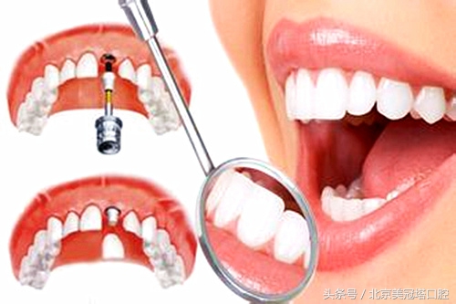 种植牙到底有多好,种植牙使用寿命10年需多少钱一颗