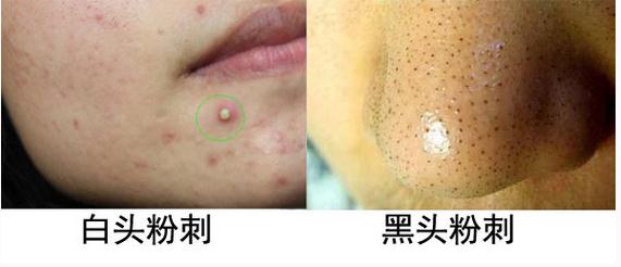 很多人不知道去痘痘,很多人分不清痤疮与毛囊炎